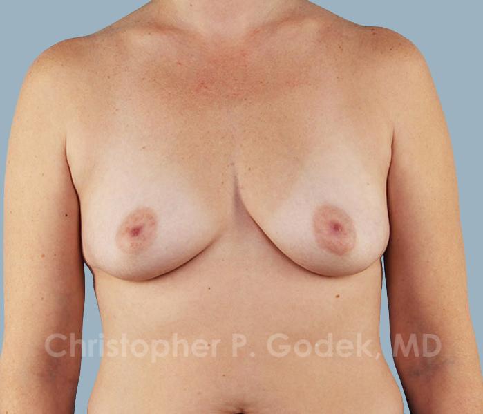 Breast Augmentation  Before & After Image