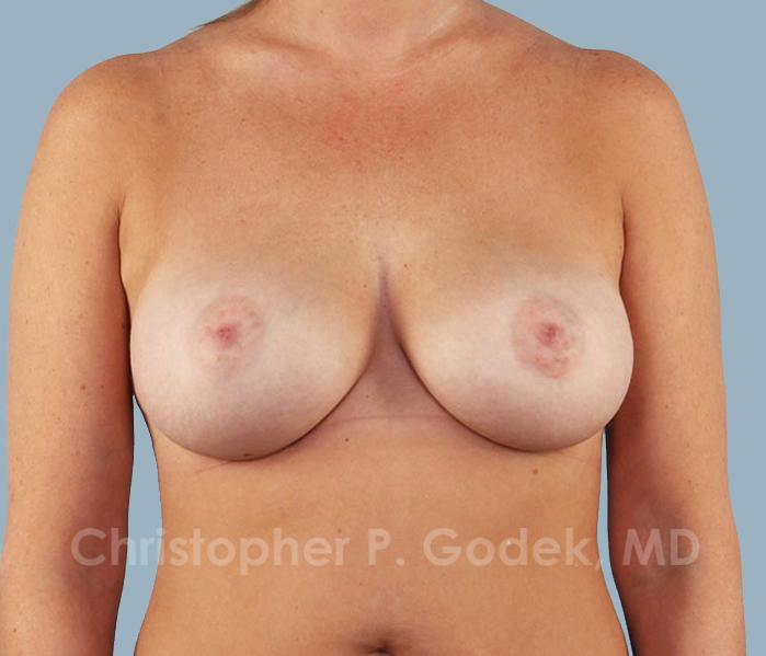 Breast Augmentation  Before & After Image