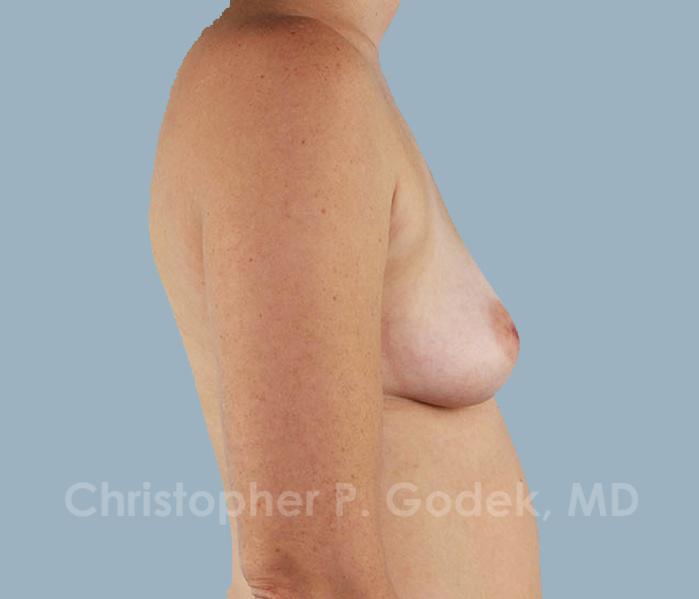 Breast Augmentation  Before & After Image