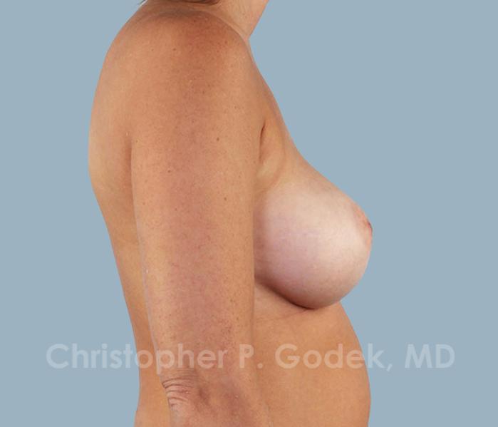 Breast Augmentation  Before & After Image