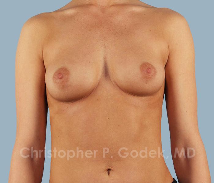 Breast Augmentation  Before & After Image