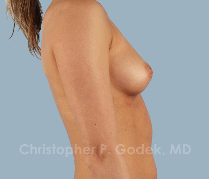 Breast Augmentation  Before & After Image