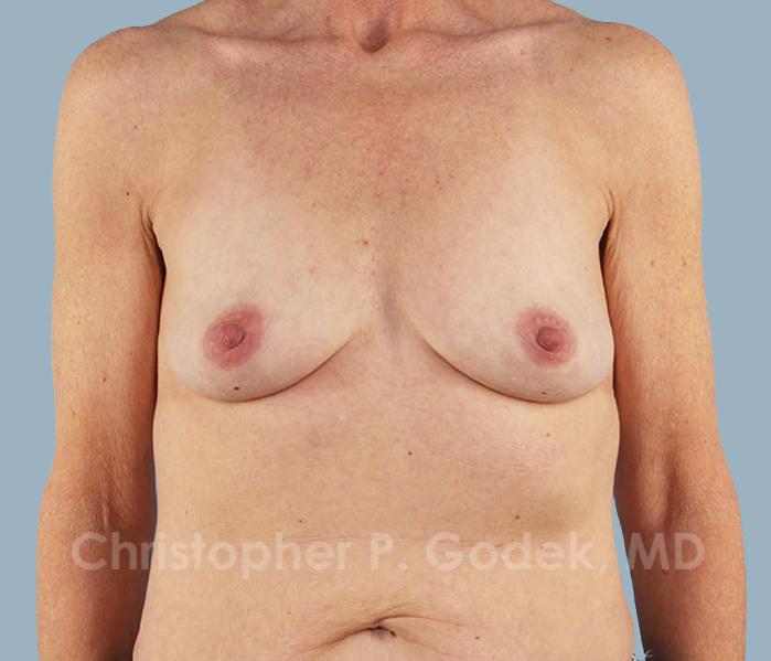 Breast Augmentation  Before & After Image