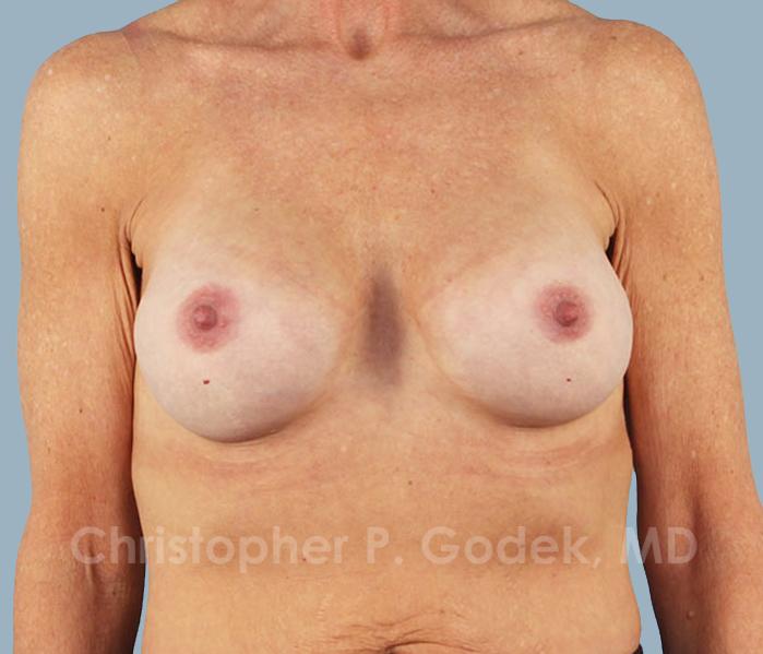 Breast Augmentation  Before & After Image