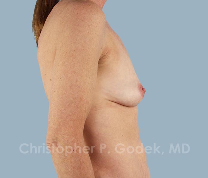 Breast Augmentation  Before & After Image