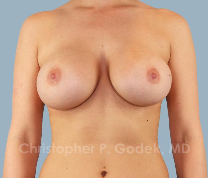 Breast Augmentation  Before & After Image