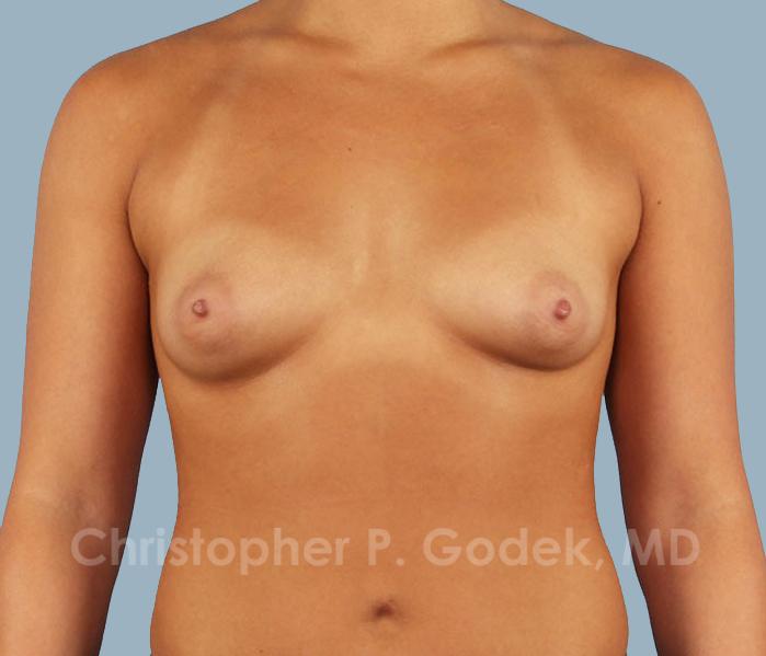 Breast Augmentation  Before & After Image