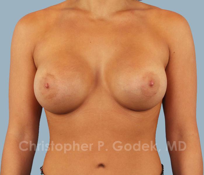 Breast Augmentation  Before & After Image