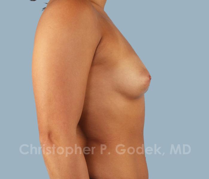 Breast Augmentation  Before & After Image