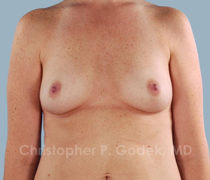 Breast Augmentation  Before & After Image