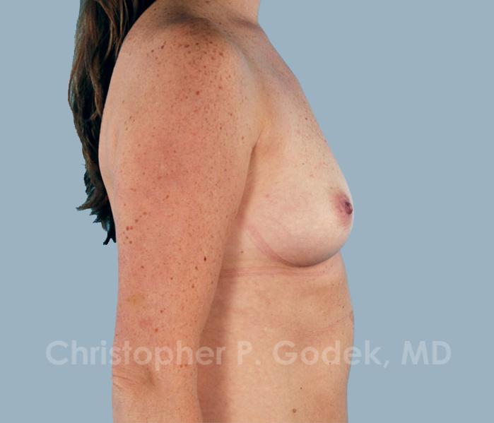 Breast Augmentation  Before & After Image