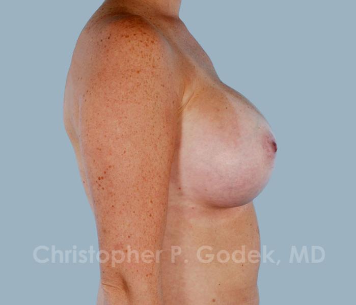 Breast Augmentation  Before & After Image