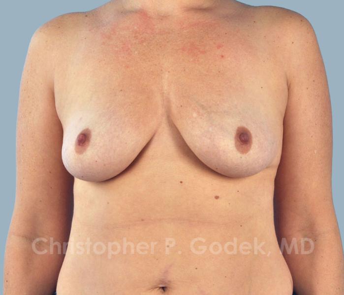 Breast Augmentation  Before & After Image