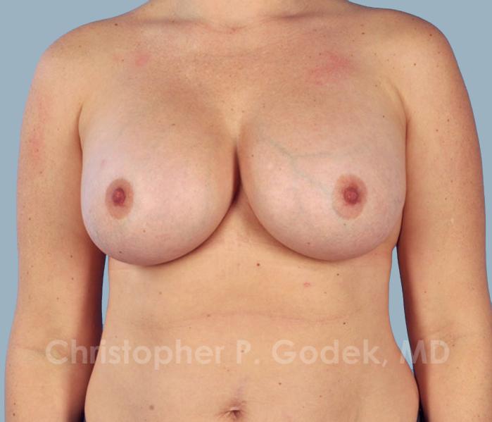 Breast Augmentation  Before & After Image