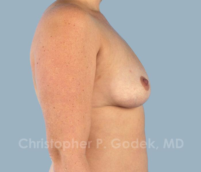 Breast Augmentation  Before & After Image