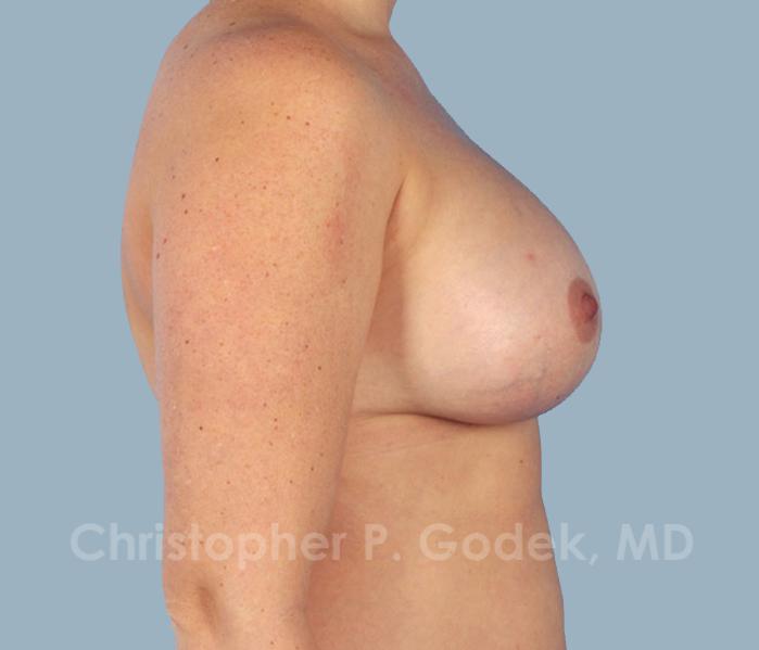 Breast Augmentation  Before & After Image