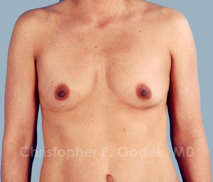 Breast Augmentation  Before & After Image