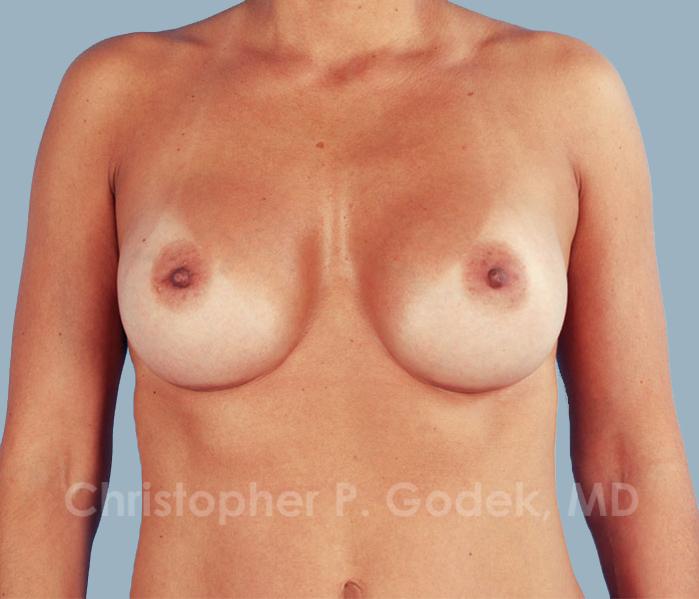 Breast Augmentation  Before & After Image