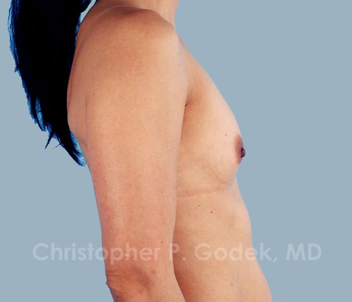 Breast Augmentation  Before & After Image