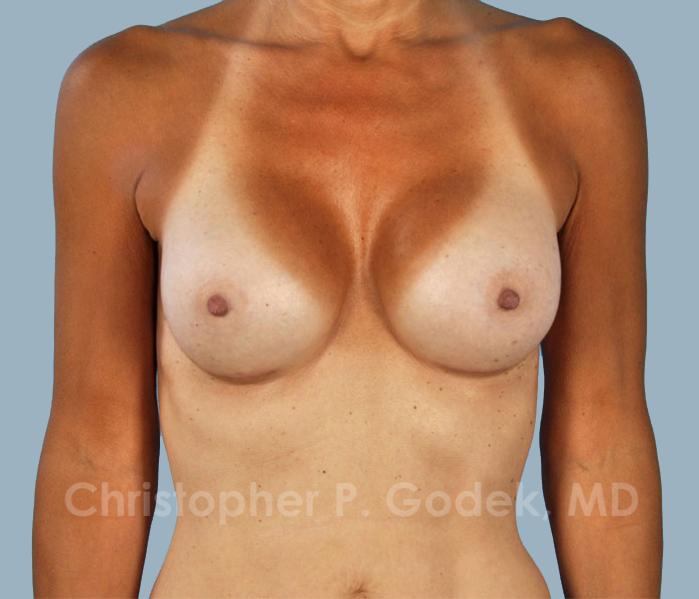 Breast Augmentation  Before & After Image