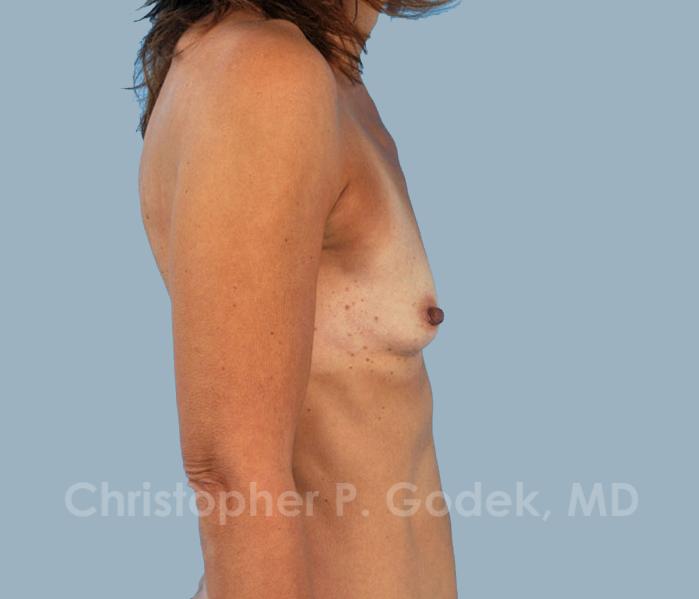 Breast Augmentation  Before & After Image