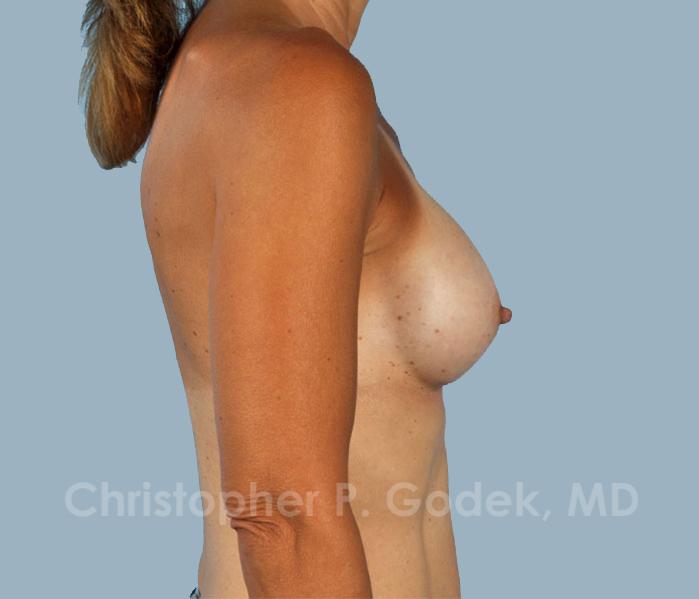 Breast Augmentation  Before & After Image