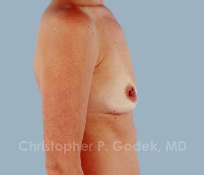 Breast Augmentation  Before & After Image