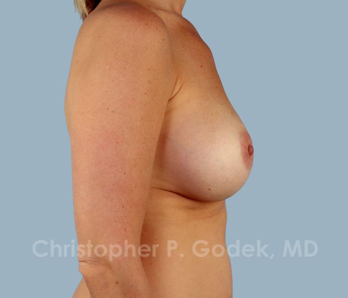 Breast Augmentation  Before & After Image