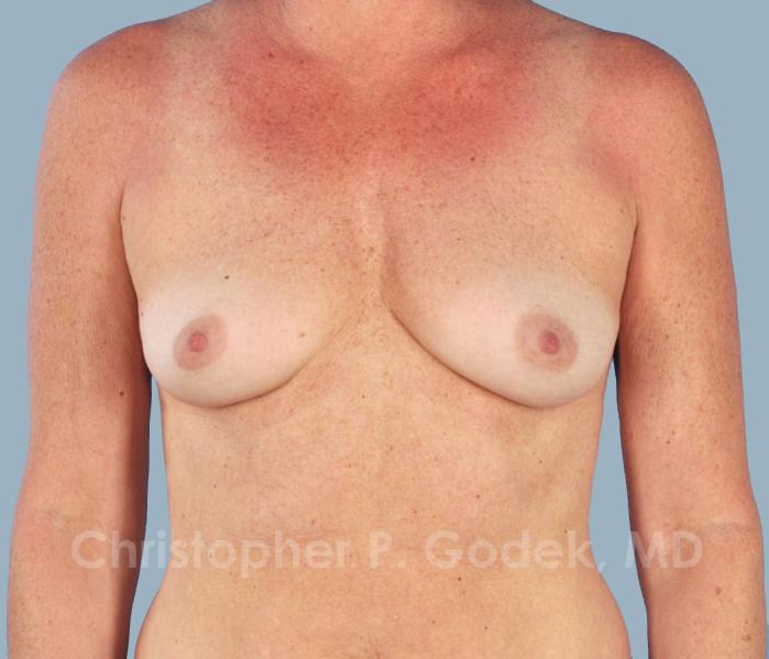 Breast Augmentation  Before & After Image