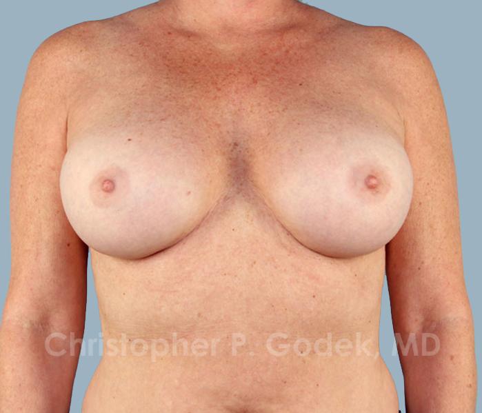 Breast Augmentation  Before & After Image