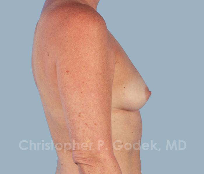 Breast Augmentation  Before & After Image