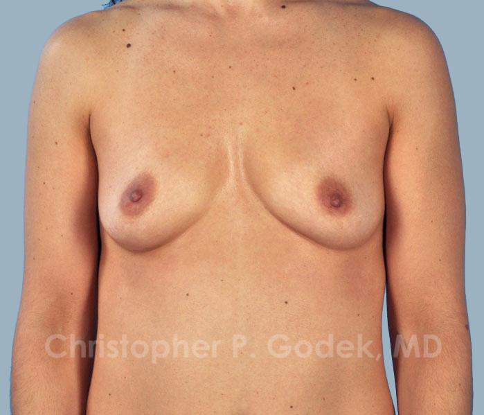 Breast Augmentation  Before & After Image