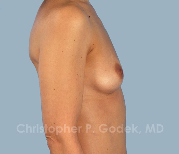 Breast Augmentation  Before & After Image