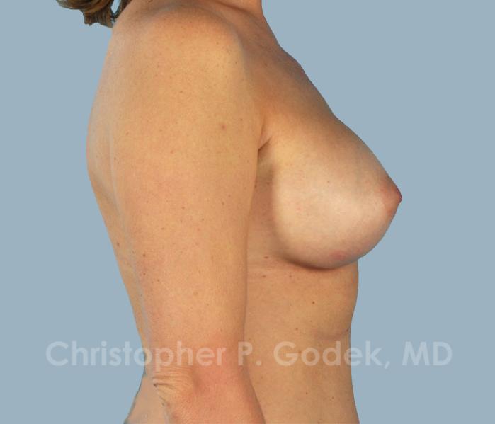 Breast Augmentation  Before & After Image