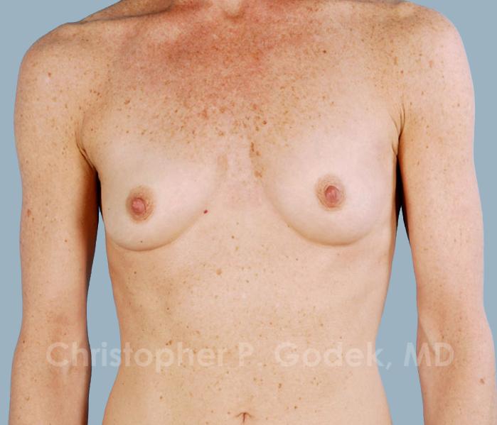 Breast Augmentation  Before & After Image