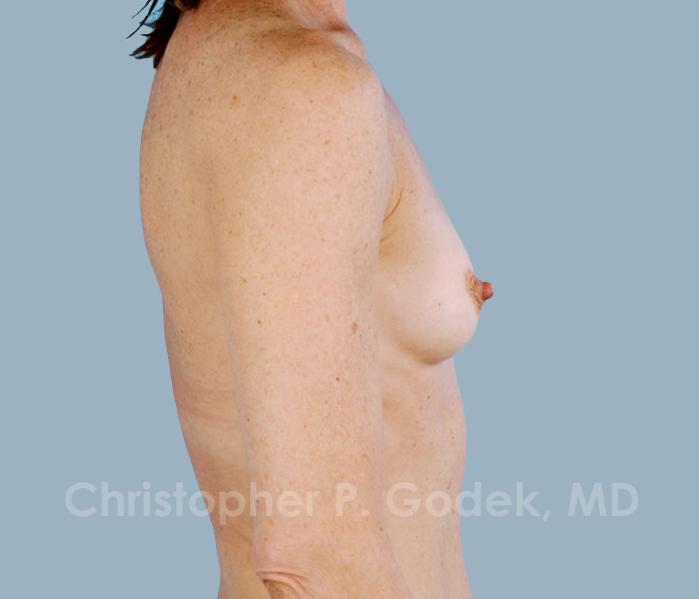 Breast Augmentation  Before & After Image