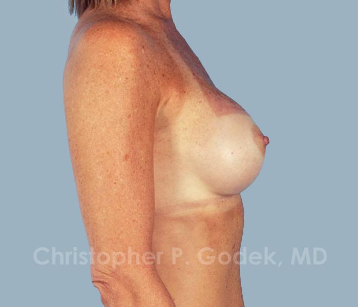 Breast Augmentation  Before & After Image