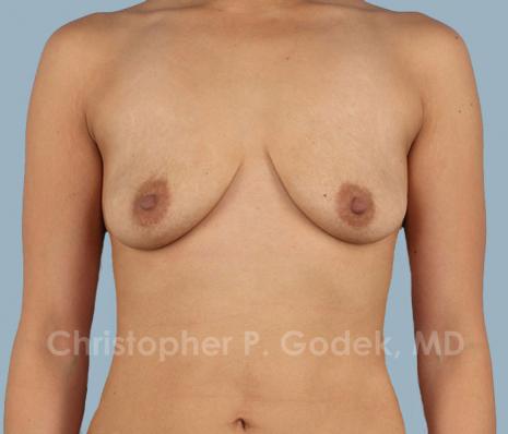 Breast Augmentation  Before & After Image