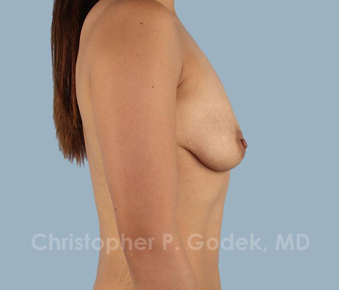 Breast Augmentation  Before & After Image