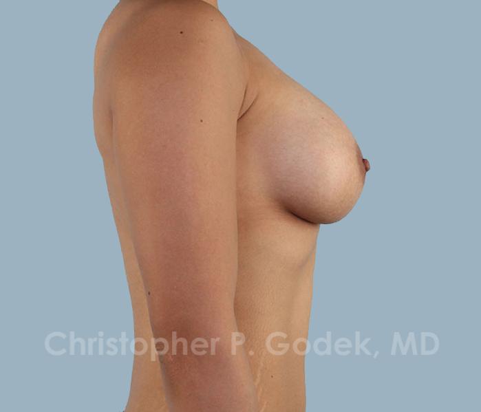 Breast Augmentation  Before & After Image