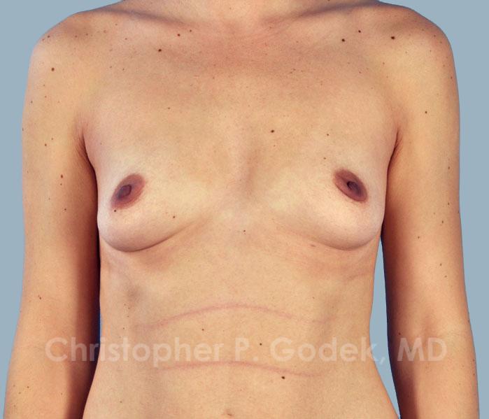 Breast Augmentation  Before & After Image