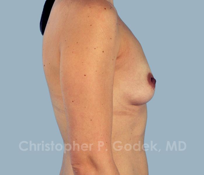 Breast Augmentation  Before & After Image