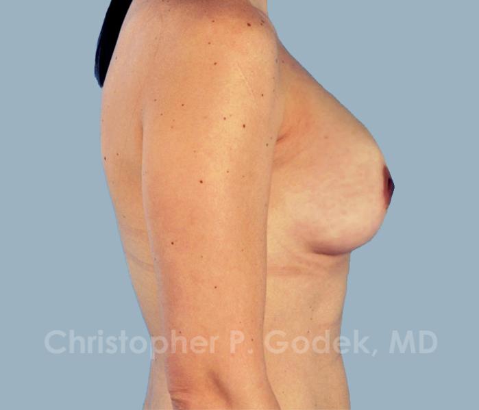 Breast Augmentation  Before & After Image