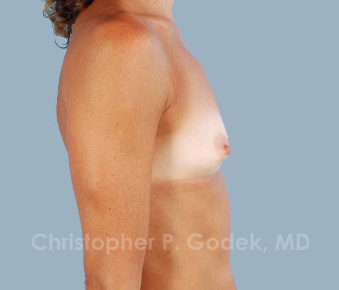 Breast Augmentation  Before & After Image