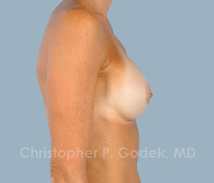 Breast Augmentation  Before & After Image