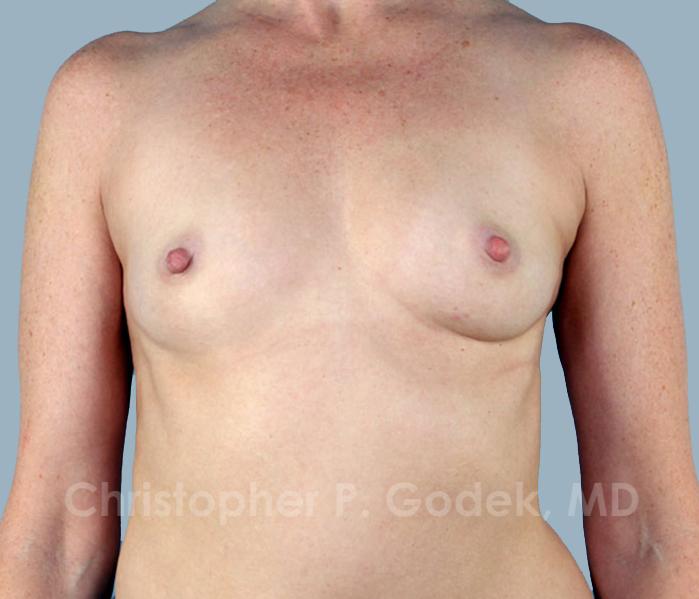 Breast Augmentation  Before & After Image