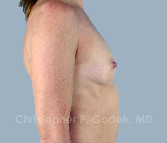 Breast Augmentation  Before & After Image