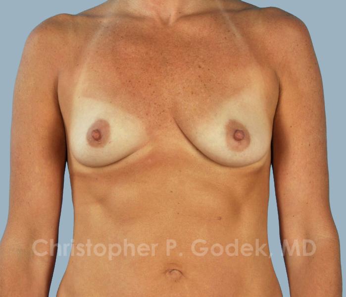 Breast Augmentation  Before & After Image