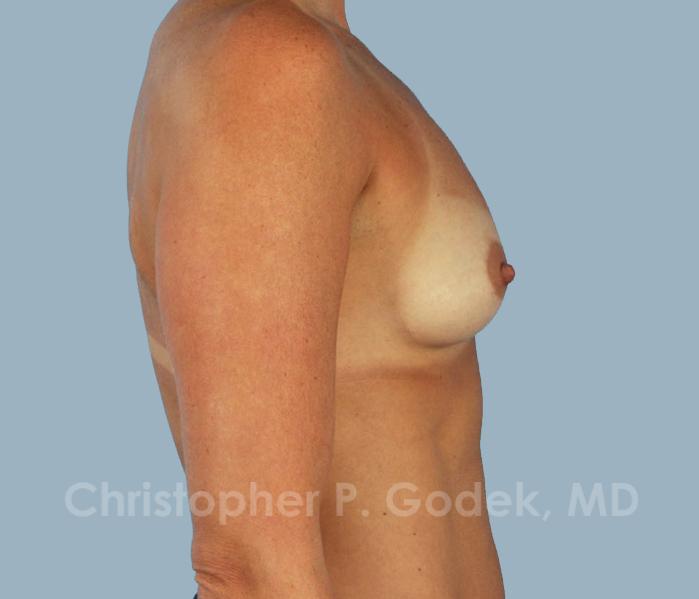 Breast Augmentation  Before & After Image