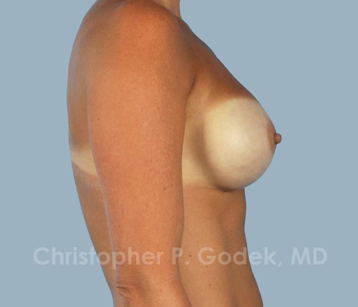 Breast Augmentation  Before & After Image